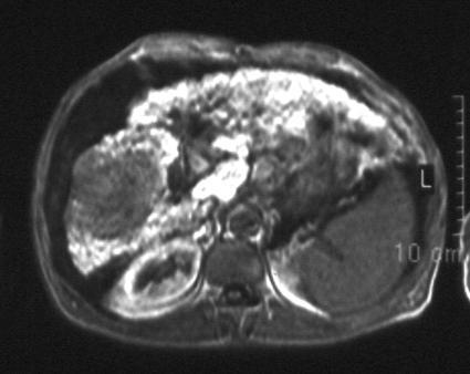 Bizonytalan természetű góc: cirrhoticus máj A karakterizálásra leginkább a kontraszt-fokozásos MRI (gadolinium) vagy a dinamikus MDCT javasolt, de egyik sem tökéletesen megbízható.