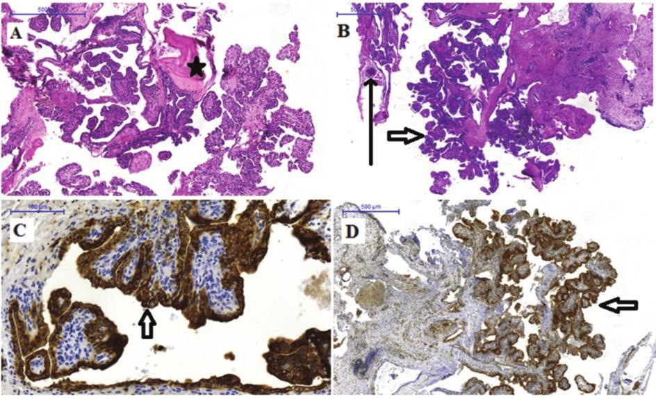 FulOrrGege_2016_3_Layout 1 2016.09.14. 12:06 Page 50 O torhinol aryngologia h ungarica 3. ábra: Saccus endolymphaticus tumor szövettani képei.