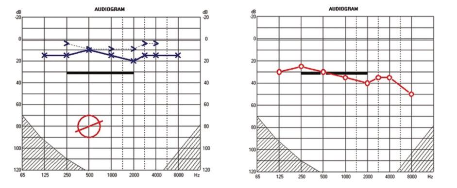 FulOrrGege_2016_3_Layout 1 2016.09.14. 12:06 Page 51 OtOrhiNOlaryNgOlOgia hungarica 5. ábra: : subtotalis petrosectomia után készült audiogram. jobb fül süket, bal oldalon ép hallás.