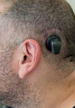 Implantálható hallókészülékek - PDF Ingyenes letöltés