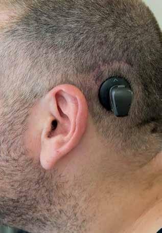 8. ábra: A Bonebridge audiológiai indikációja vezetéses és kevert halláscsökkenés esetén 6. ábra: Baha-készülék beültetése után a gyógyult műtéti területre felhelyezett beszédprocesszor 9.