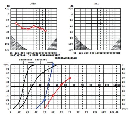 A CODACS (Cochlear s direct-acoustic-cochlear-stimulator; Cochlear, Ausztrália, Sidney) készülék (13), súlyos fokú, kevert típusú kétoldali halláscsökkenés esetén indikált, megfelelő