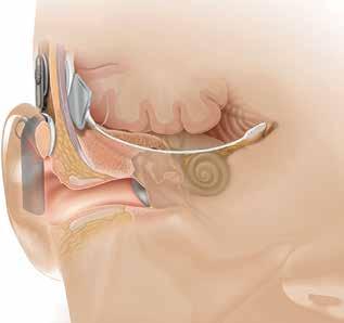 Implantálható hallókészülékek - PDF Ingyenes letöltés