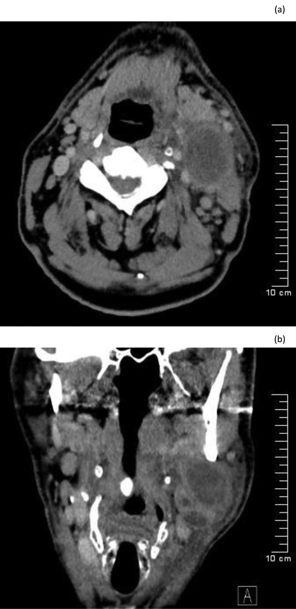 Rövidítések CRP = C-reaktív protein; CT = (computed tomography) komputertomográfia; DNS = dezoxiribonukleinsav; FDG = 18Ffluor-dezoxi-glükóz; HPV = humán papillómavírus; PCR = (polymerase chain
