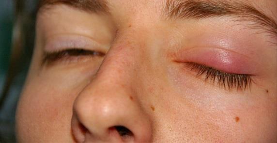 blepharitis (szemhéjgyull.