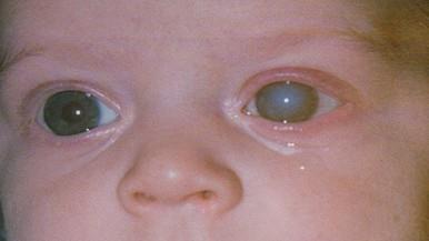 Szembetegségek Glaucoma