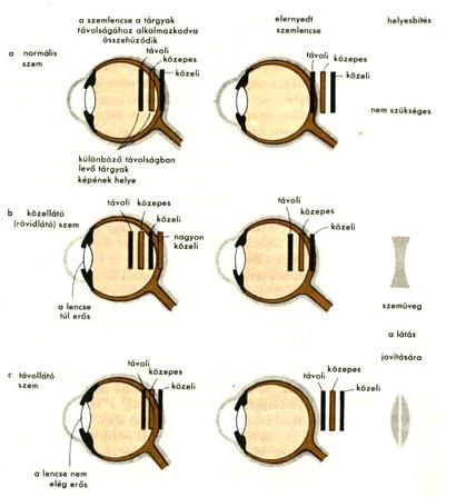 Myopia