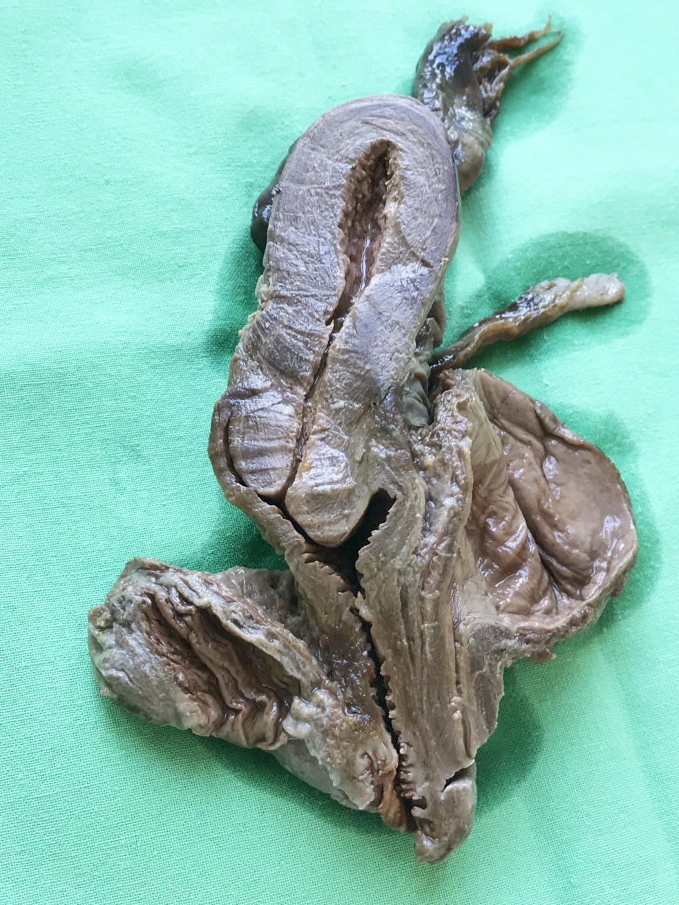 Vagina - fornices fornix vaginae