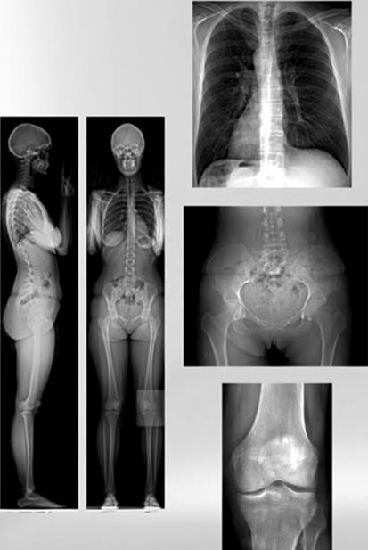 ábrák felhasználása az EOS Imaging, Párizs, Franciaország engedélyével történt) 2. ábra EOS berendezés által készült röntgenfelvételek.