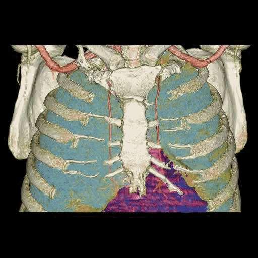 3D MRI (Nemes Balázs SE