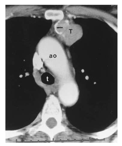 Thymoma Strollo,
