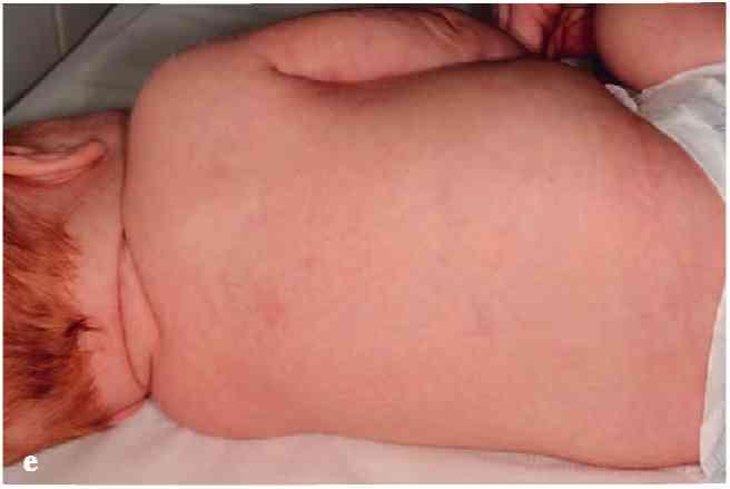 Állapota stabilizálódott, a nasalis BiPAP, majd CPAP (Continous Positive Airway Pressure) kezelését 4 nap után le lehetett állítani.