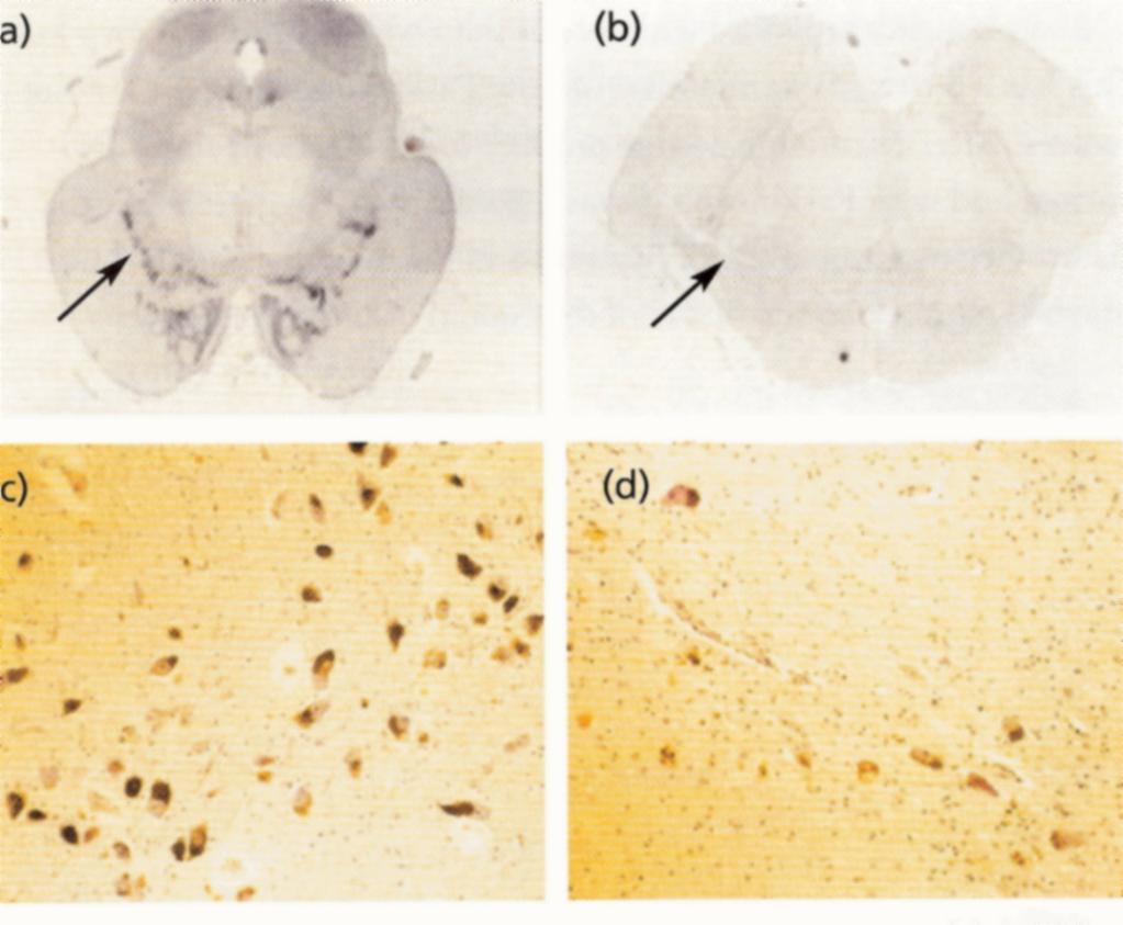 Normális substantia nigra Parkinson