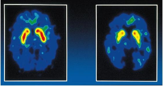 A dopaminerg transzmisszió hiányossága: positron