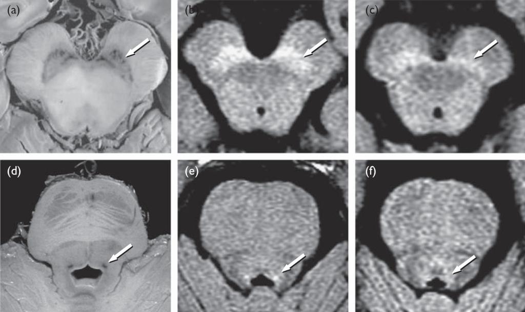 Neuromelanin érzékeny mágneses rezonancia imaging