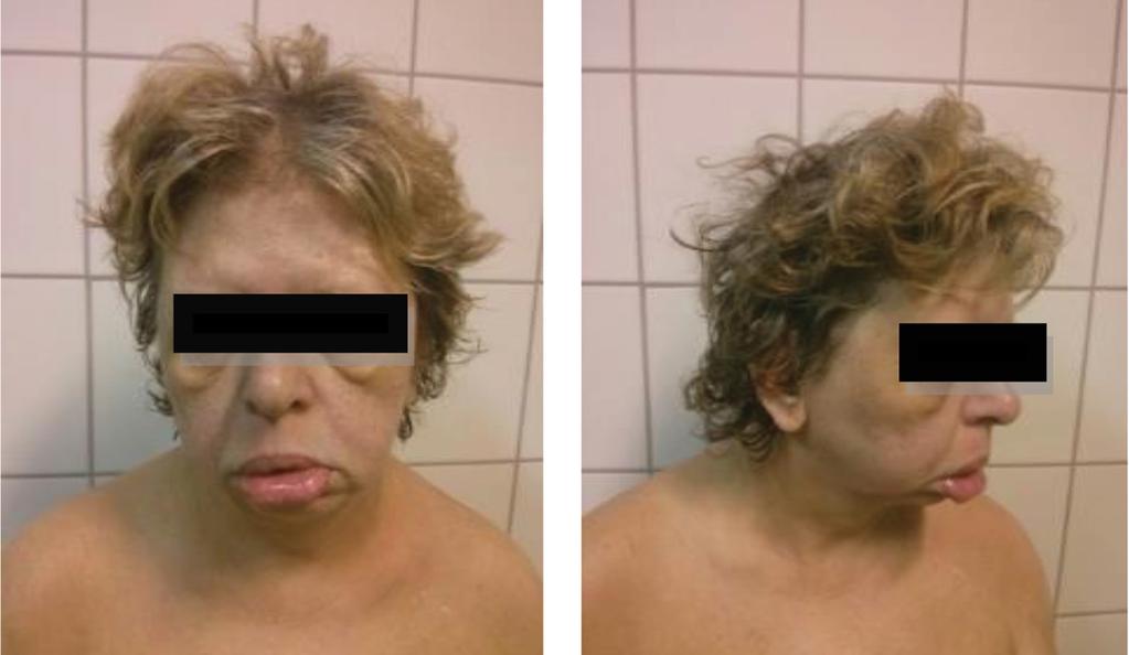 1. ábra A WS-re jellemző facialis dysmorphiás jelek felnőtt betegnél külleme, főleg a vastag alsó ajak, nyitott szájtartása, kicsi álla, hosszú filtruma, duzzadt szemei, széles orrgyöke és