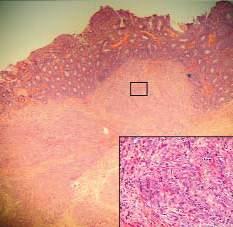 KARDOS ÉS MTSAI MAGYAR UROLÓGIA, XXVIII. ÉVFOLYAM, 1. SZÁM (2016) 6. ÁBRA: UROTHELIALIS KARCINÓMA PATKÁNYBAN VÉGZETT ILEOCYSTOPLASTICÁT KÖVETŐEN 24 HÓNAPPAL (HE, 6 ).