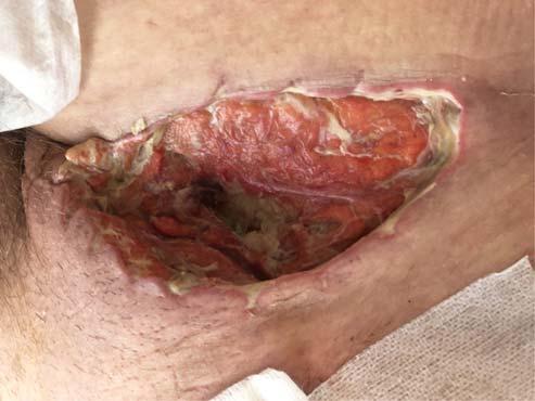 A posztoperatív szakban egy napig intenzív megfigyelést igényelt, majd ezt követően pulmonológián folytatódott kezelése, ahol az 5.