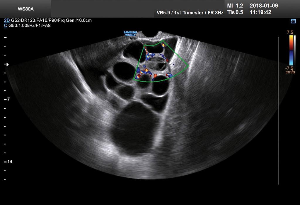 szindróma 2. ábra Hiperstimulált petefészekben color-doppler-vizsgálattal a tüszők körül kifejezett érújdonképződés (neovascularisatio) figyelhető meg 4.