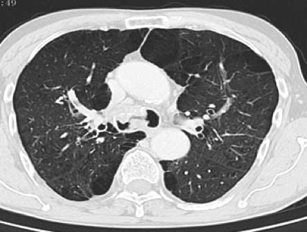 Az ECMO indikációját 3 esetben képezte extrém súlyos légcsőszűkület. Az 1. beteg esetében (12.