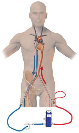 szívó kanül visszaadó kanül back flow kanül pumpa oxigenátor 29. ábra Perifériás VA-ECMO: a szívó kanül a v. cava inferiorban, a visszaadó kanül az aortában helyezkedik el.