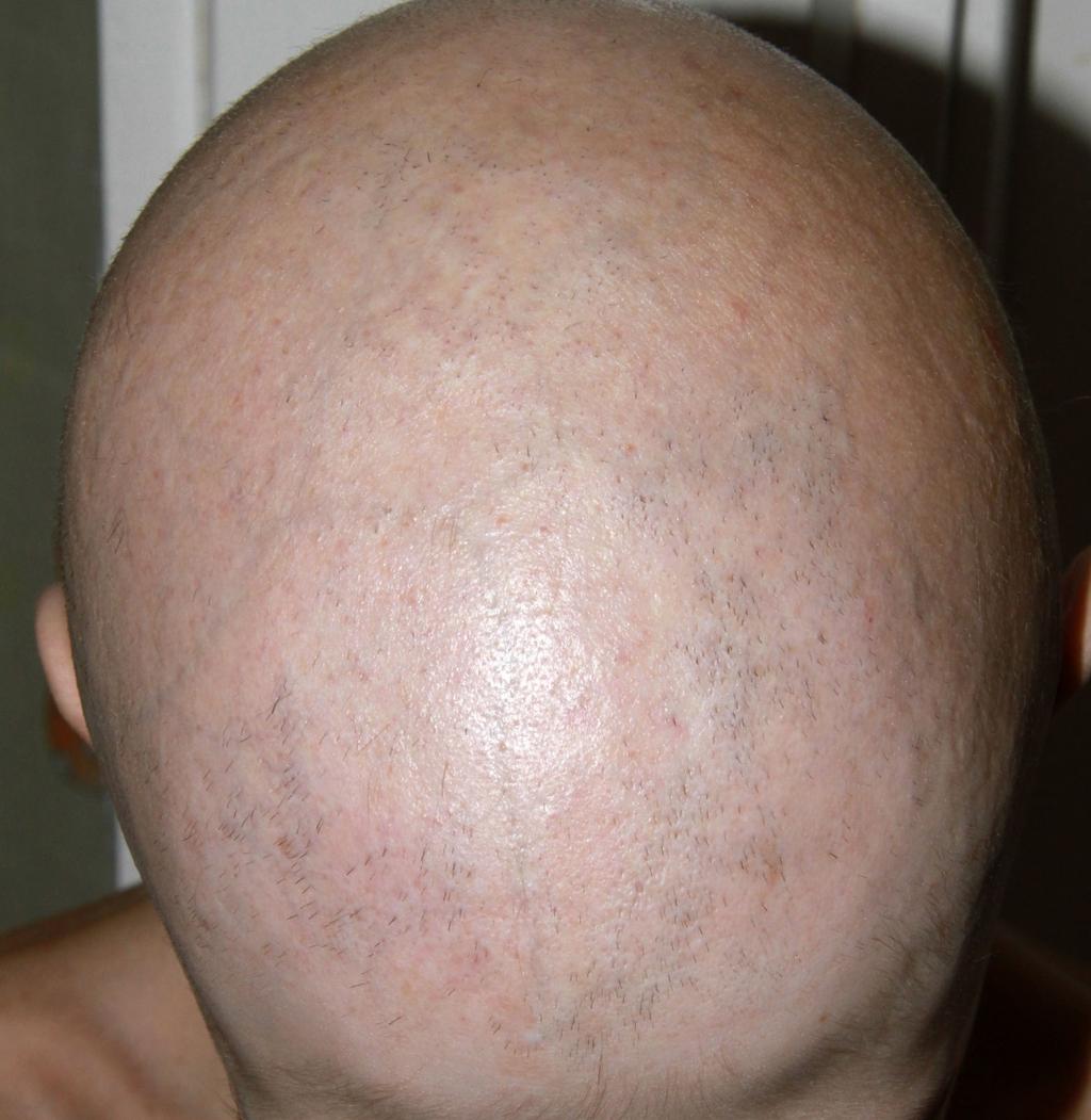 3/b ábra Diffúz alopecia STAT1-mutációban spektrum alapján az AD STAT1-GOF-mutációs eseteket szindrómás CMC-ként osztályozhatjuk [16].