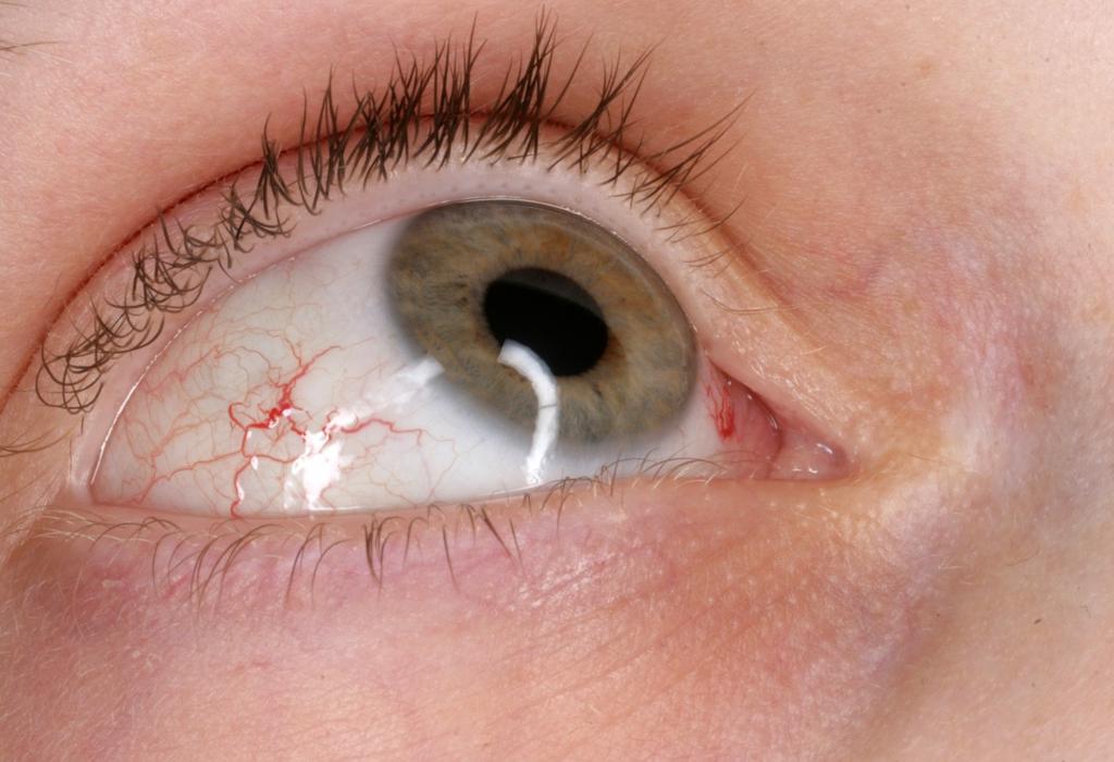 ket, nem erythemás, széli részei nem körülhatároltak (erythema marginatum). Nagyon fontos hangsúlyozni, hogy a bőrtünetek nem azonosak az urticariában tapasztaltakkal [27].