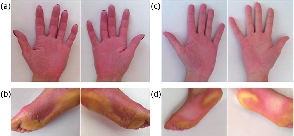 89 2. ábra: A bőrgyógyászati tünetek: a 29 éves beteg (a) tenyéri és (b) talpi tünetei, a 24 éves beteg (c) tenyéri és (d) talpi tünetei tációt heterozigóta hordozói státuszban sem azonosítottunk.