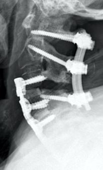 Poliszegmentális nyaki gerinccsatorna-szűkület és atlanto-axiális instabilitás rheumatoid arthritisben CIV-V anterior discectomia, CVI parciális corpectomia és CIII-VII lemezes ventrofixációra került