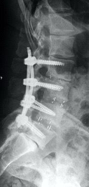 Posztoperatív flat back deformitás kezelése korrekciós műtéttel Dr. Lazáry Áron PhD Dr. Biczó Ádám Dr. Bereczki Ferenc Országos Gerincgyógyászati Központ aron.lazary@bhc.