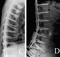 A műtét során a lumbosacralis szegmentumban Smith-Peteren osteotomiával (SPO) kiegészített lordózis-korrekciót, illetve ileumokra történő stabilizáció kiterjesztést végeztünk (3. ábra).