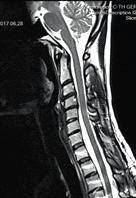 Spine (Phila Pa 1976). 2017 Feb;42(3):E150-E155. doi: 10.1097/BRS.0000000000001732. Matsumoto Y.