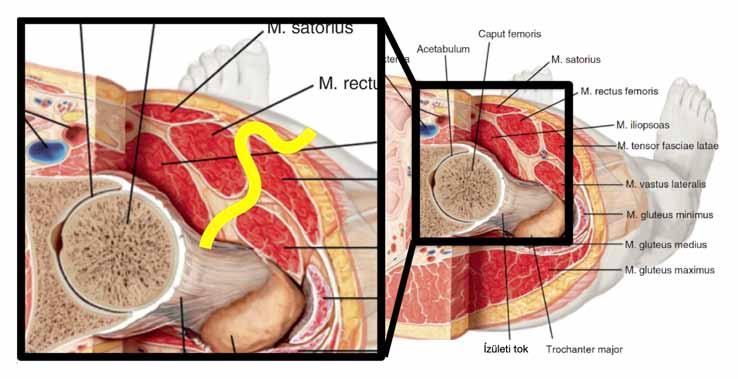 Az elülső vagy anterior (DAA- direct anterior approach) feltárás során a csípőízület elülsőoldalsó részén, az izomhasak között lehet megközelíteni a csípőízületet.
