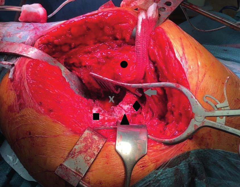 ANYAG ÉS MÓDSZER Betegszelekció Retrospektív vizsgálatunkba a klinikánkon 2016 2017 között medence diszkontinuitás miatt APC (DePuy Protrusio Cage DePuy Orthopaedics, Inc, Warsaw, IN) és csontgraft