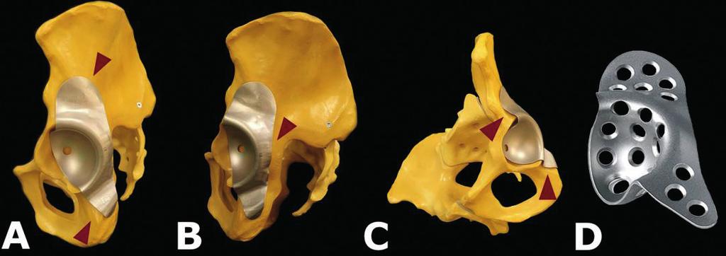 Kiterjedt acetabularis csontdefektusok (Paprosky 3B medence diszkontinuitással) kezelése impaktált csont allograft és ilioischialis cage használatával 4.