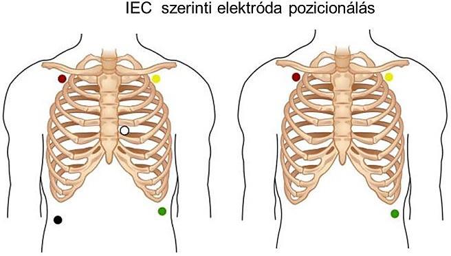 - ha a beteg ujjai hidegek, a szenzor szennyeződik, vagy leveszi az oigénszint mérő szenzort, a szaturáció hirtelen leesik, vagy kérdőjelet ír a gép - ha a fehér