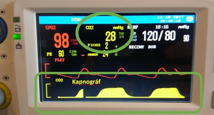 Lélegeztetés, oigén terápia paraméterei A lélegeztetőgép mutatja, ha nem vagy biztos kérdezz, keresd a sorban előző paramétereket és az alapján azonosítsd a gépen.