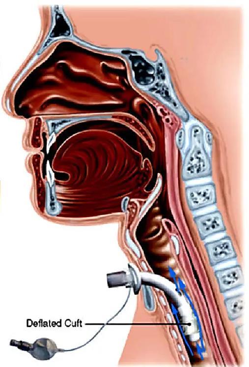 amelynek során nem használnak endotracheális tubust.