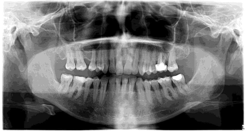 KIINDULÁSI ORTHOPANTOMOGRAM FELVÉTEL