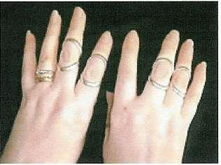 A V-splint
