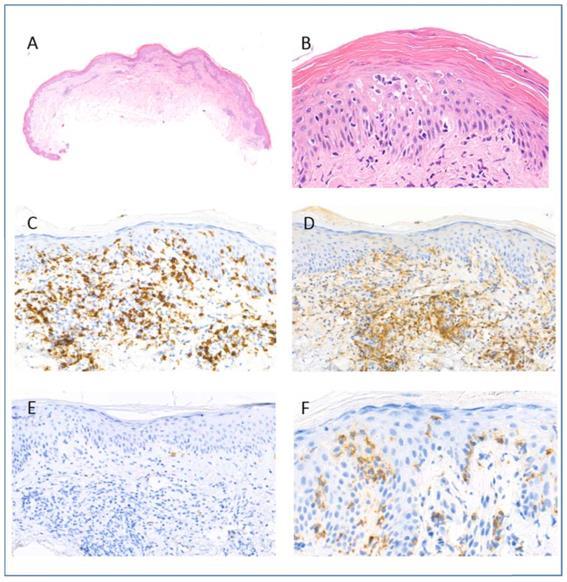 10. ábra B típusú lymphomatoid papulosis (5. páciens anyaga) A. A biopsziás anyagban szuperficiális perivaszkuláris dermális infiltrátum észlelhető az epidermisz hiperpláziája nélkül. (H&E festés). B. Mérsékelt epidermotropizmus, amelyben a hámot infiltráló sejtek kis, hiperkromatikus, atípusos limfoid sejtek.