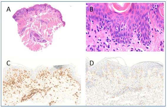 11. ábra Lymphomatoid papulosis B típusa (2. páciens anyaga) A.