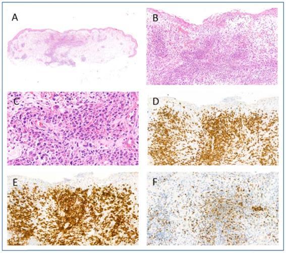 12. ábra C típusú lymphomatoid papulosis (6. páciens anyaga) A. A biopsziás anyagban atrófiás epidermisz és ék alakú limfoid infiltrátum látható a dermiszben (H&E festés). B.