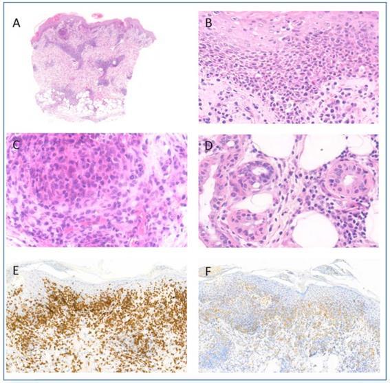 13. ábra D típusú lymphomatoid papulosis (8. páciens anyaga) A.