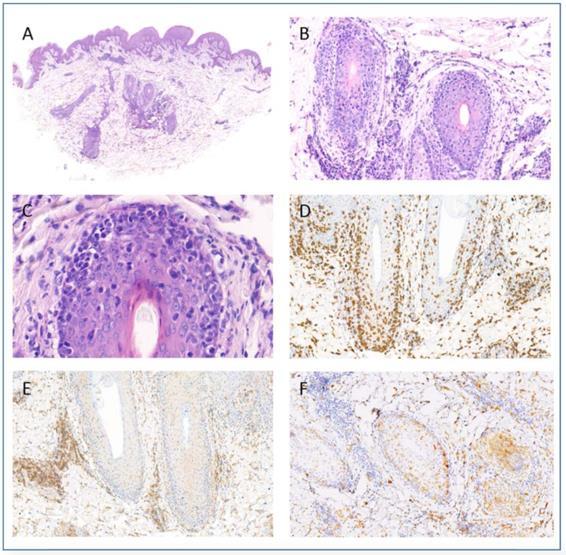 14. ábra F típusú lymphomatoid papulosis (14. páciens anyaga) A. Leginkább perifollikulárisan elhelyezkedő dermális infiltrátum és enyhe epidermális hiperplázia (H&E festés). B.