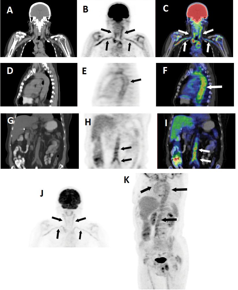 2. táblázat A F-FDG-PET/CT-vel vizuálisan aktív nagyér-vasculitises betegekben az érfalérintettség értékelése Az érfal vizuális pontszáma Supraaorticus ágak Thoracalis aorta Abdominalis aorta Arteria