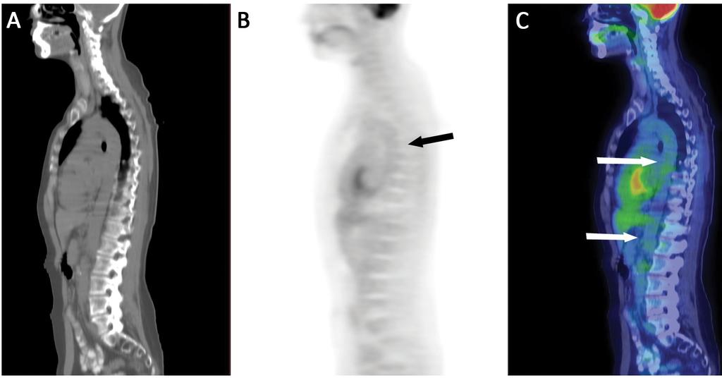 ER ED ETI K ÖZLEM ÉN Y 2. ábra F-FDG-PET/CT-negatív vizsgálat. Klinikailag aktív nagyérvasculitis gyanúja miatt elvégzett F-FDG-PET/CT vizsgálat.