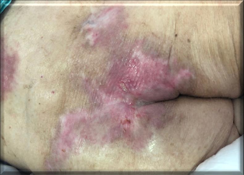 I. stádium Nem kifehéredő erythema az arteriolák dilatációja miatt, a bőr kívülről még