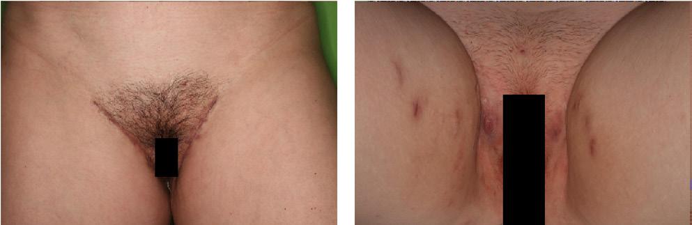 Rövidítések ANA = (antinuclear antibody) antinukleáris ellenanyag; BMI = (body mass index) testtömegindex; COX = (cyclooxygenase) ciklooxigenáz; DHEAS = (dehydroepiandrosterone sulfate)