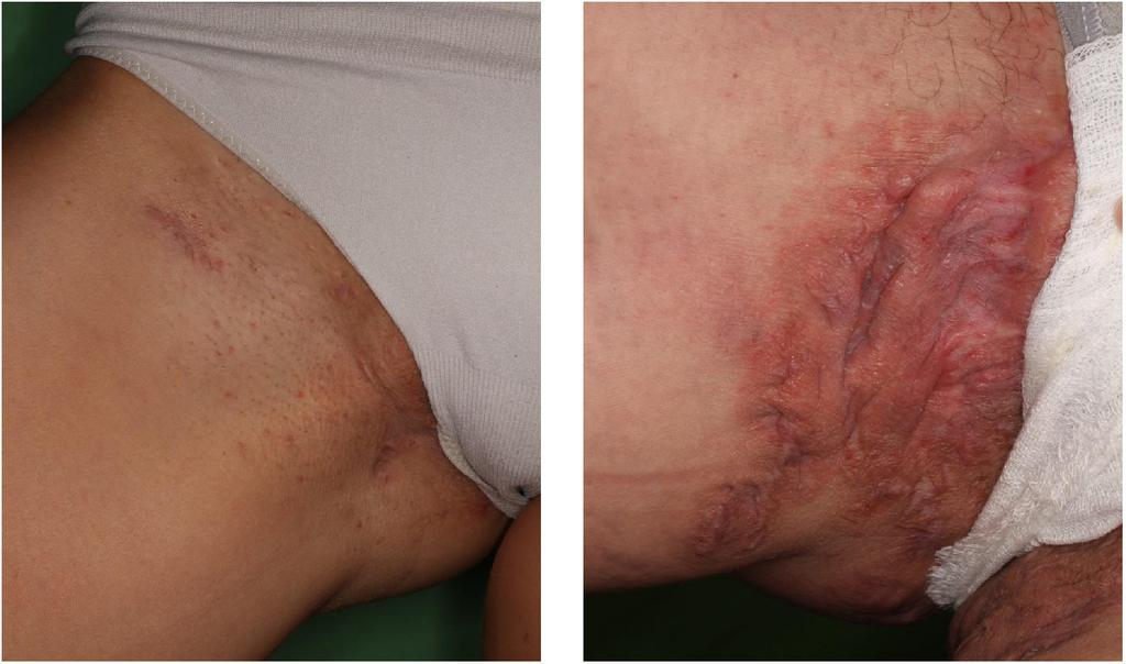 immundeficientiavírus; HPV = humán papillomavírus; HS = hidradenitis suppurativa; MRI = (magnetic resonance imaging) mágnesesrezonancia-vizsgálat; NSAID = (nonsteroidal antiinflammatory drug)